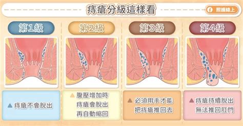 為什麼會長痔|痔瘡是什麼？症狀、原因、診斷、治療